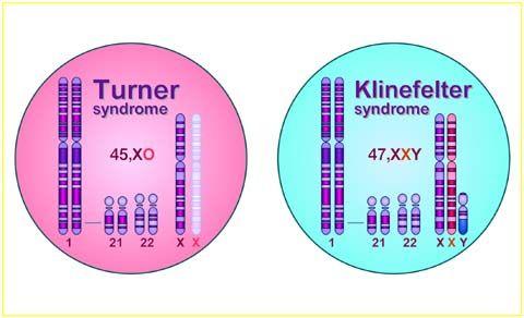 Chromosomal Disorders Down syndrome: trisomy 21, three copies of the 21st chromosome Turner s