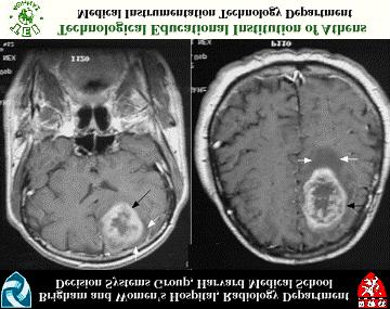 Some typical MRI images (a)