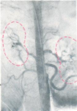 Subtraction Angiography