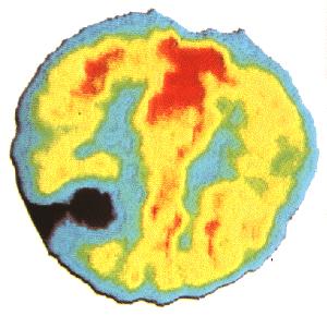 PET scan of a heart following acute myocardial infarction and thrombolytic therapy The Rubidium areas show