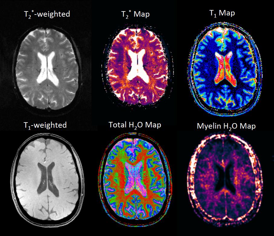 Fig. 1. Conventional T2 -weighted (top left) and T1 -weighted (bottom left) magnetic resonance images of a transverse slice through the brain of a MS patient.