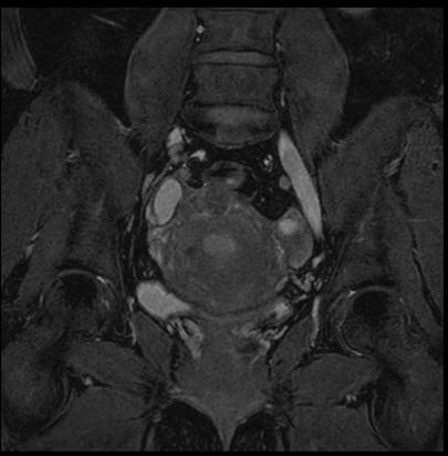 Pelvis with myoma comparison w/wo In this MRI exam of pelvis in a patient with myoma, is used to accelerate