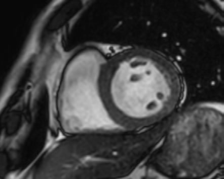 Cardiac MRI of acute