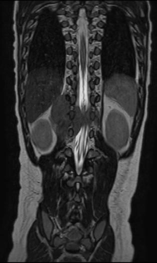 Pediatric spine with neuroblastoma This 6-year-old patient with neuroblastoma