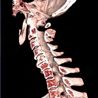 Cervical Spine range (msv) This