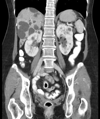 The images demonstrate extensive polycystic disease with