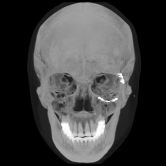 Facial Bones range Helical 0.