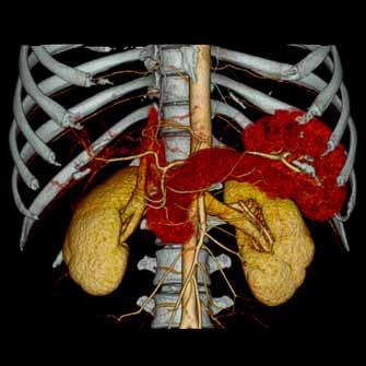 Renal CT Angiogram Helical 0.