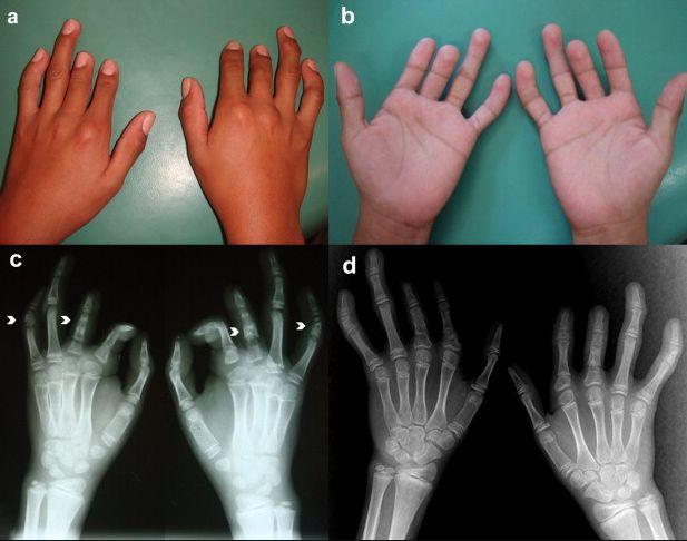 Punnett square problem Hypothetically, the B allele causes brachydactyly while b alleles cause
