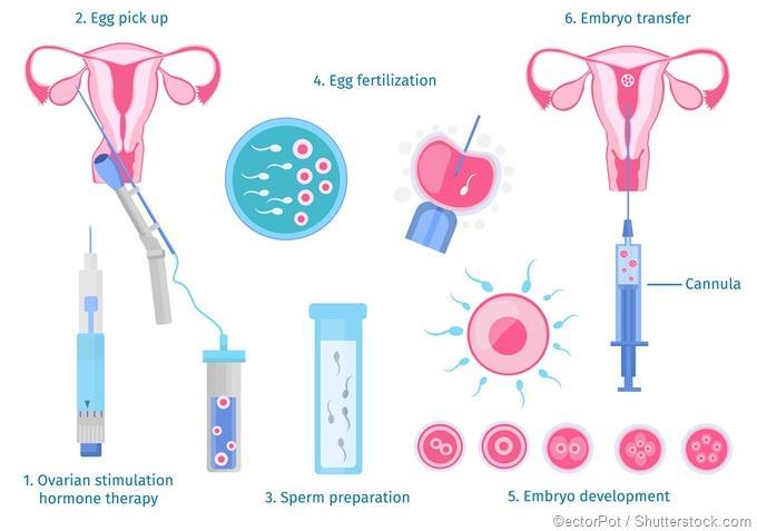 Reproductive Technologies In vitro fertilization involves the collection of both sperm from