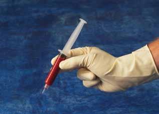 Preparation of the Clotalyst Autologous Serum Step 1: Draw Draw 12ml of citrated blood in a 12ml syringe (1ml of