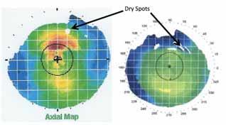 TREATING THE OCULAR SURFACE TO OPTIMIZE CATARACT OUTCOMES By Marguerite B. McDonald, MD Figure 3. Topography readily identifies preoperative dry eye. patients' measurements for cataract surgery.