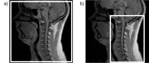 5.3.3 In Vivo Field Maps and Fat Suppression Figure 5.7 shows an example of the two in vivo shim volumes used for each volunteer on a T1-weighted central sagittal slice.