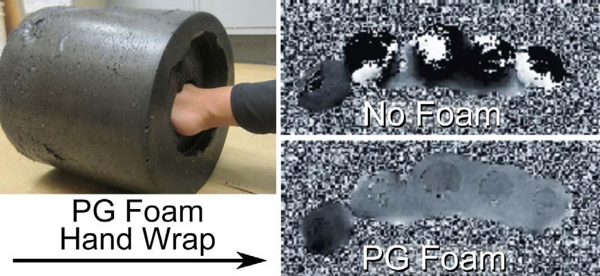 Fig 6.4: Improved fat suppression in the foot with PG foams. Fig 6.