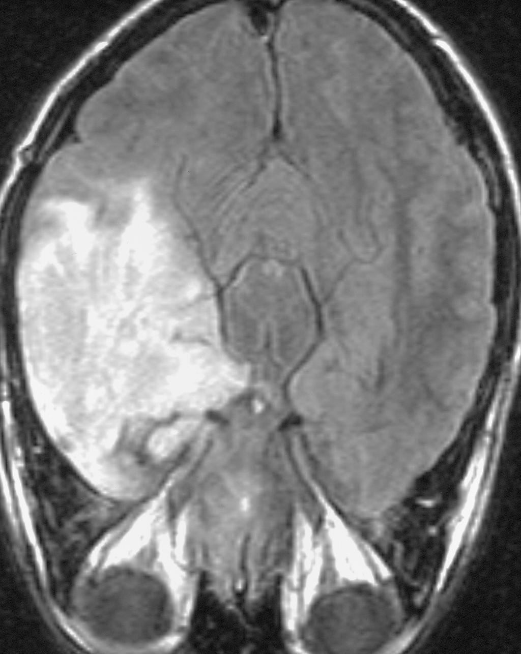 Figure 1(a). Axial images of a patient with a low grade glioma. (a) A T1 weighted image showing the tumour as a dark region relative to brain, due to its longer T1.