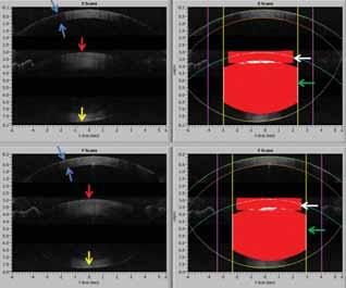 Figure 2. Imaging of the crucial structures of the anterior segment with real-time optical coherence tomography (OCT) prior to treatment with the OptiMedica laser cataract system.