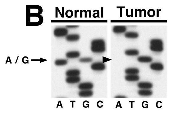 Tumor gene