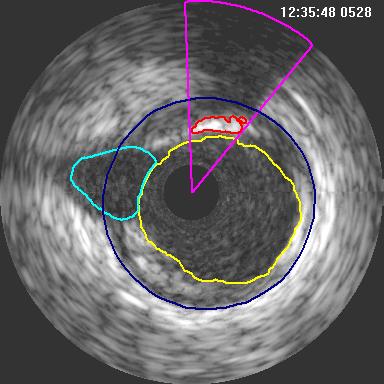 Intravascular Ultrasound Image Analysis Detected Features in