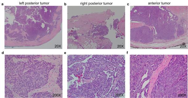 Figure S3. Histopathology of the metastatic ovarian tumors.