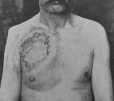 Early Radiation Injury 1898 Photograph shows severe chest burn on a United States soldier in the Spanish-American War, caused by repeated exposure to X rays.