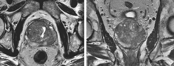 94 MRI IN CLINICAL PRACTICE FIGURE 7.3. Axial T 2 -weighted images of seminal vesicles (left), and prostate gland (right) in a patient with BPH and acquired with an endorectal coil at 1.5 Tesla.