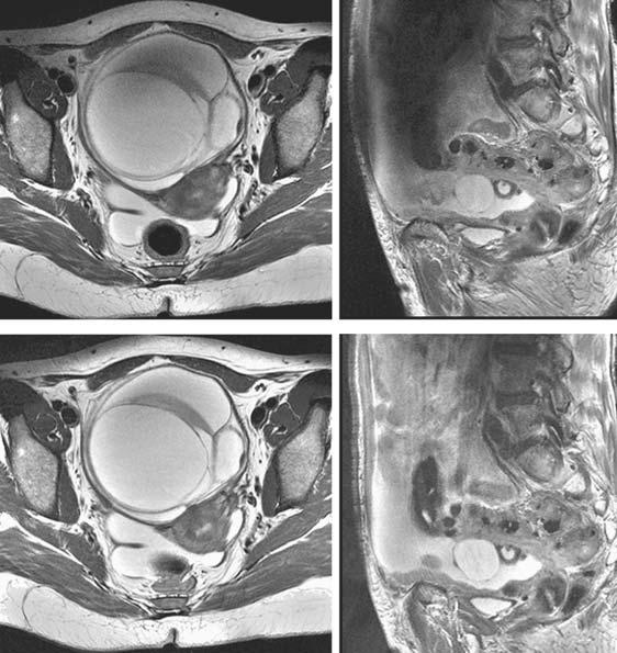 98 MRI IN CLINICAL PRACTICE FIGURE 7.6. 3.0 Tesla images of the ovary (top) illustrate the problem associated with the increased dielectric effect at high field.