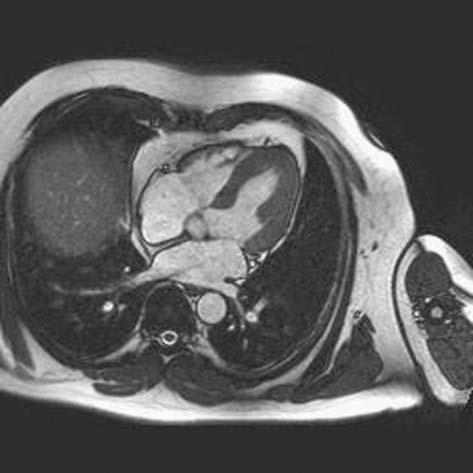 8. CARDIAC MRI 105 FIGURE 8.3. Four-chamber view of the heart demonstrating the relationships of the ventricles and atria.