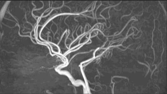 112 MRI IN CLINICAL PRACTICE FIGURE 9.2. An example of a 3D TOF angiogram of the circle of Willis, which has been displayed using a maximum intensity projection (MIP).