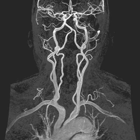 9. MR ANGIOGRAPHY 113 FIGURE 9.3. CE-MRA demonstrating coverage from the aortic arch to the intracranial vessels. center of k-space is being acquired. There are several ways to ensure this.