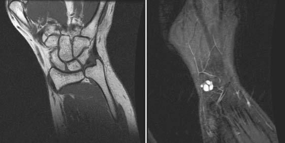 122 MRI IN CLINICAL PRACTICE FIGURE 10.3. Example wrist images in a patient. (left) T 1 -weighted image shows trabeculae detail and (right) a ganglion is seen in this fatsuppressed image.