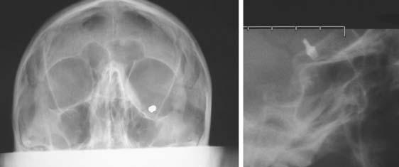 32 MRI IN CLINICAL PRACTICE FIGURE 2.2. (left) An orbit x-ray taken as part of patient screening reveals this air-gun pellet.