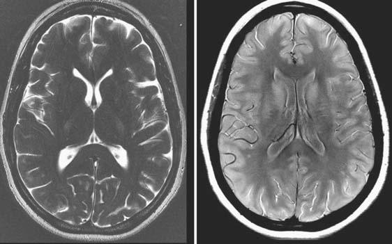 38 MRI IN CLINICAL PRACTICE FIGURE 3.5. (left) TE increased to 300ms to accentuate the T 2 -weighting; (right) Low TE to produce more mixed (proton-density) weighting.