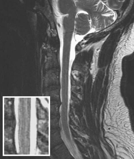 42 MRI IN CLINICAL PRACTICE FIGURE 3.8. Artifactual lines of high signal appear in the spinal cord due to ringing (shown in inset).