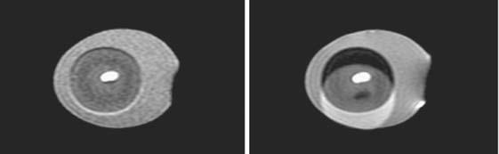 46 MRI IN CLINICAL PRACTICE FIGURE 3.11. Images of an egg acquired at two different bandwidths (left) ±32kHz, and (right) ±3.9kHz. All other parameters were kept constant.