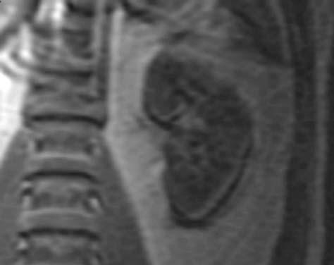 3. SCAN PARAMETERS AND IMAGE ARTIFACTS 47 FIGURE 3.12. In vivo example. Here the effect can be seen in the vertebra and around the kidney (frequency direction is top to bottom).