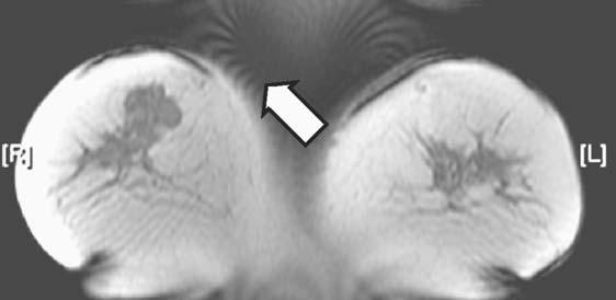 50 MRI IN CLINICAL PRACTICE FIGURE 3.15. Example of moire interference fringes observed in this coronal breast image.