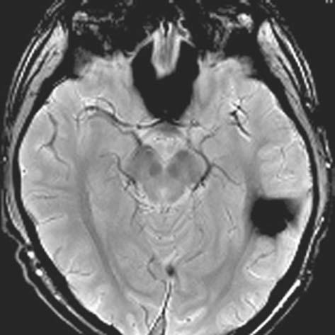5. BRAIN AND SPINE 65 FIGURE 5.1. T 2 *-weighted image demonstrates the presence of a hemorrhage. sequences. Examine loss of internal architecture and signal changes.