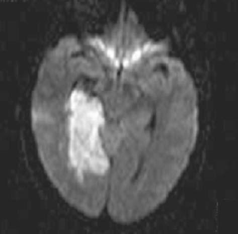 66 MRI IN CLINICAL PRACTICE FIGURE 5.2. Diffusion-weighted EPI image with b = 1000s/mm 2 in a patient following a stroke. The ischemic region is clearly visible as the high signal.
