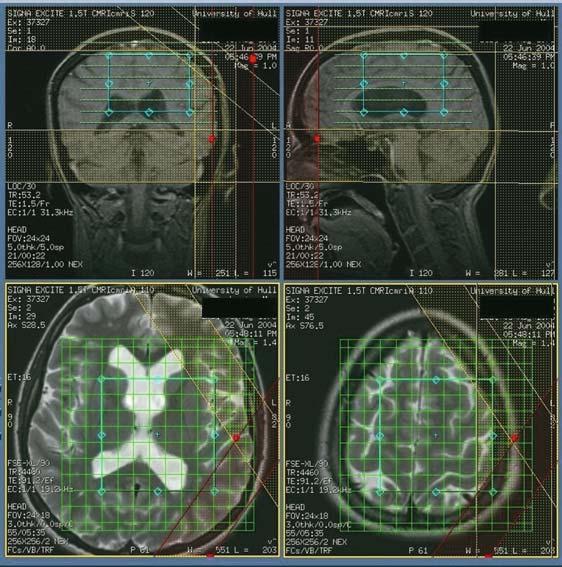 5. BRAIN AND SPINE 69 FIGURE 5.4. Graphical prescription of the MRS volume of interest. Figure 5.4 demonstrates a typical scanner console display during the prescription of a MRSI examination.
