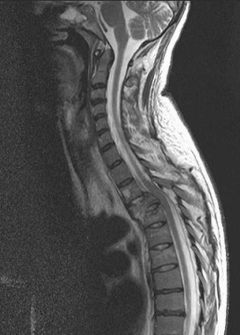 5. BRAIN AND SPINE 75 FIGURE 5.8. Sagittal T 2 -weighted C-spine image demonstrating trauma. Example sequence: FSE TE/TR = 83/4200 ms. Sagittal T 1 W.
