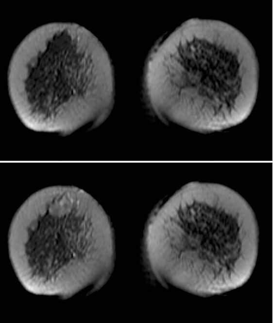 80 MRI IN CLINICAL PRACTICE FIGURE 6.1. (top) Pre-contrast breast image in the coronal plane using a FSPGR sequence. (bottom) A post-contrast image at the same slice location.