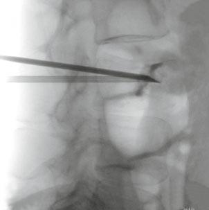 The small needle is the RFA needle and placed in the center of the tumor. Case 2: Skeletal Intervention A 61-year-old woman presented with pain in the lumbar spine.