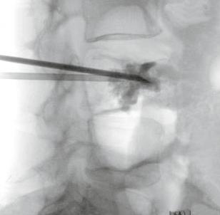 04 White Paper No. 02/2009 Fig. 7: Lateral fluoroscopic image shows the cement placed into the vertebra at the end of the procedure, located in the center of the vertebra. No leakage is noted. Case 3.