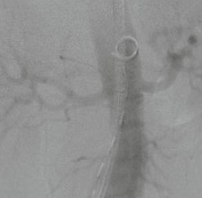 The dilation of the aneurysm had been only slightly progressive in those years. However, an operation or intervention became necessary this year.