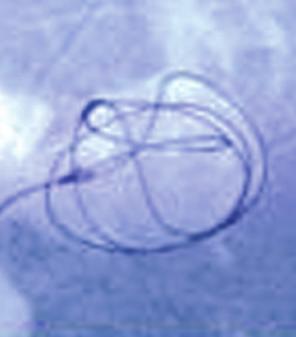 microcatheter tip deflection while coiling