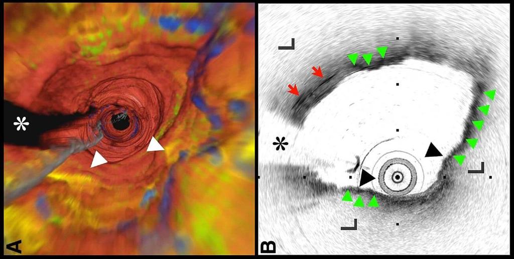 II.4 optical coherence tomography Patient OFDI-02 Images of a Distal Right Coronary Artery Thin-Capped Fibroatheroma (A) Fly-through view (distal-proximal), demonstrates a circumferential lipid-rich