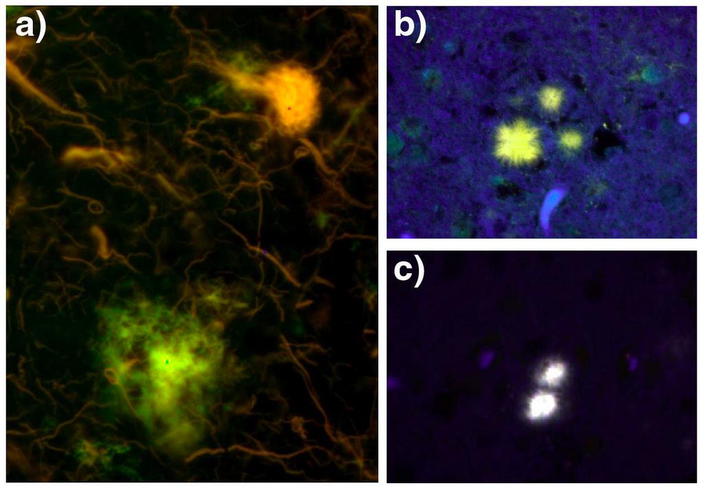 Figure 2: LCP staining of protein deposits in brain tissue from human patients with AD or Creutzfeldt- Jakob disease (CJD). a) LCP stained brain tissue from a patient with AD.