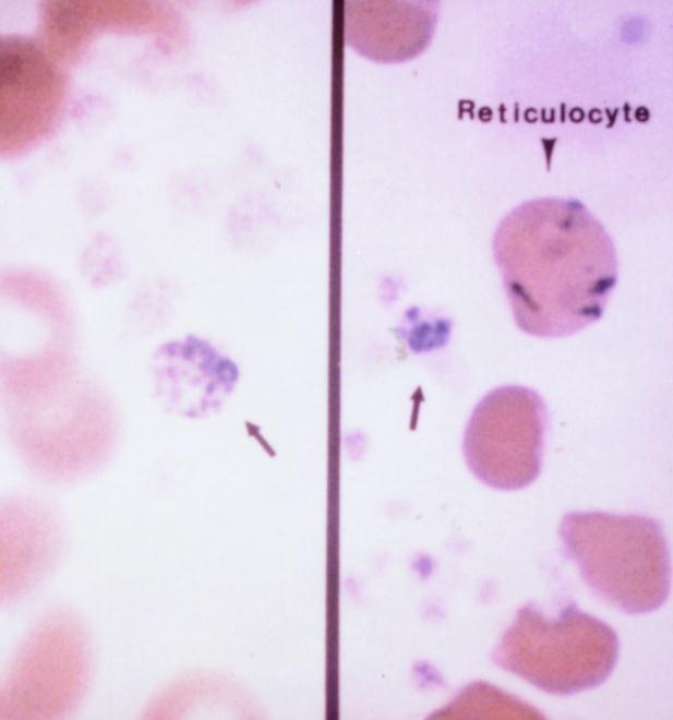 IPF- reticulated platelets First described by Ingram & Coopersmith (1969) in peripheral blood of dogs following acute blood loss, and they referred them to platelets with increased RNA content Newly