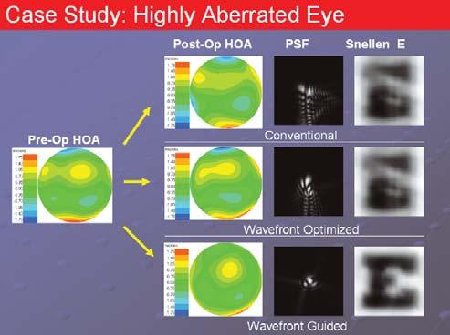 8 ASCRS Washington, DC Show Daily Supplement Building a Wavefront-Driven Refractive Practice Optimized vs. Wavefront-Guided Ablations: Is There a Difference?