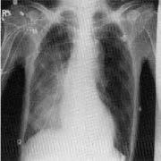 mortality Key inclusion criteria Pneumonia has been acquired outside the hospital or diagnosed within 72 hours after